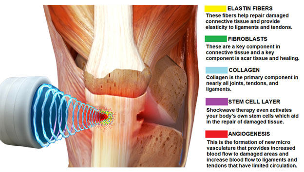 shock wave therapy