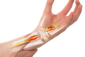 Chiropractic Care for Carpal Tunnel Syndrome